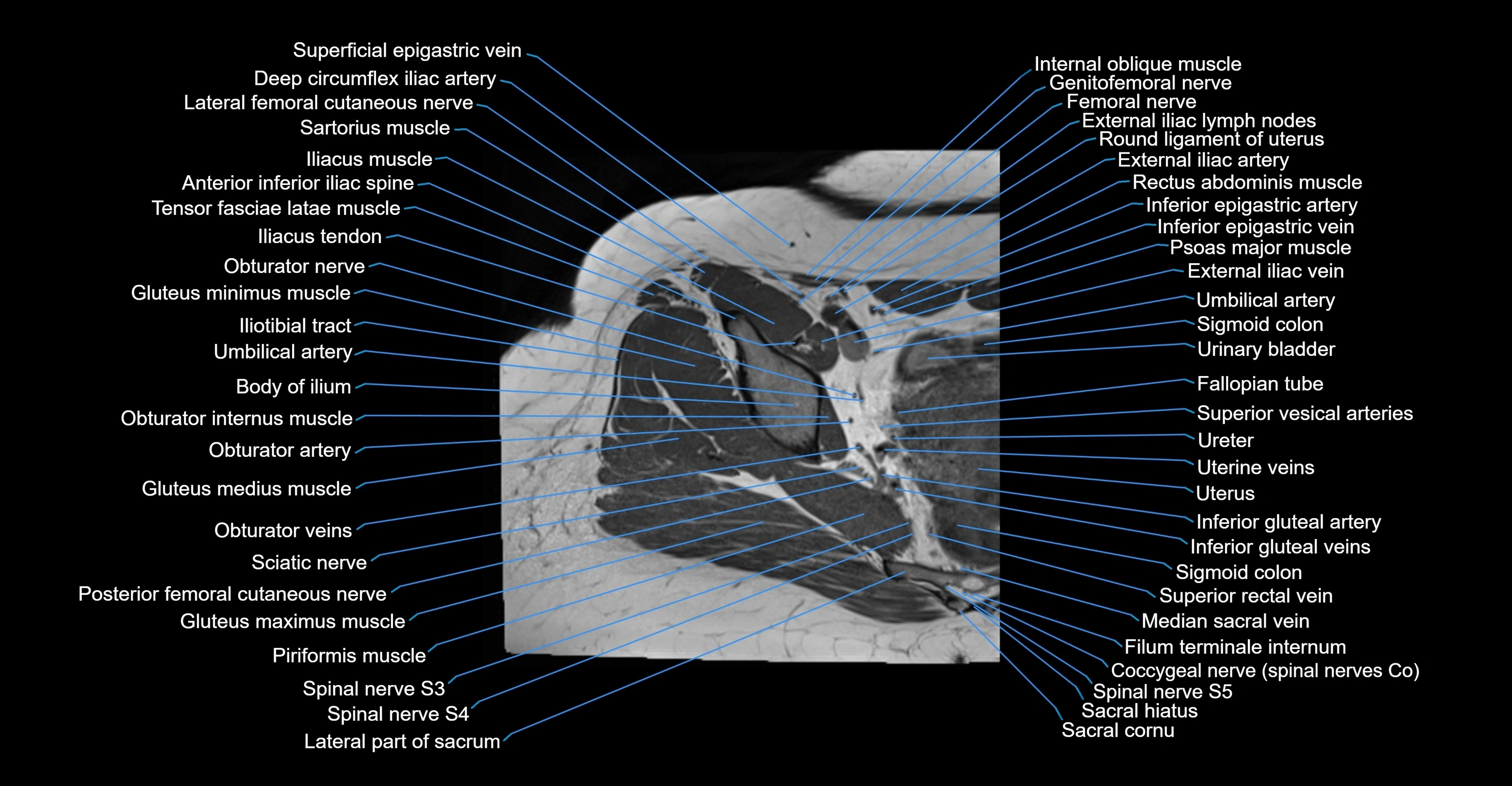 MRI hip axial cross sectional anatomy 3T 3D  radiology  anatomy image-img-00001-00020.webp